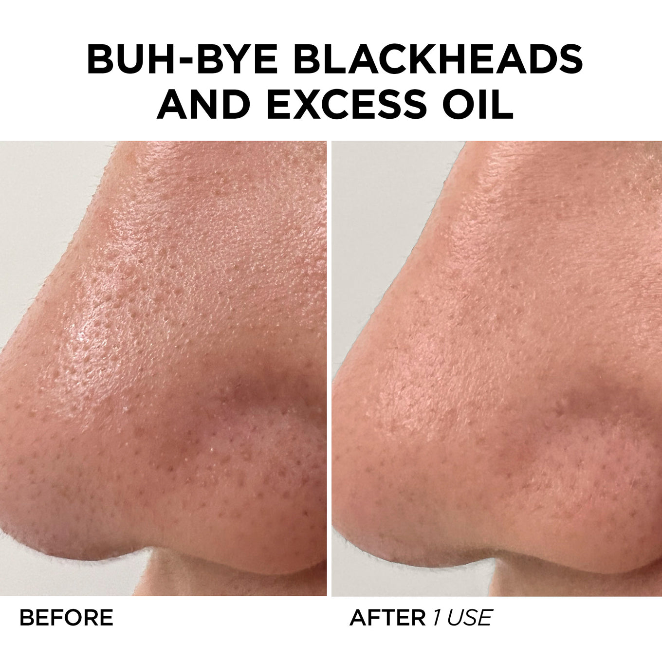 Lustre Blackhead & Pore Vacuum